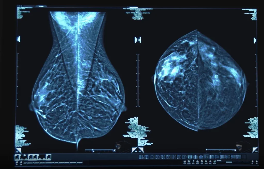 Маммография Самостоятельное обследование молочных желез