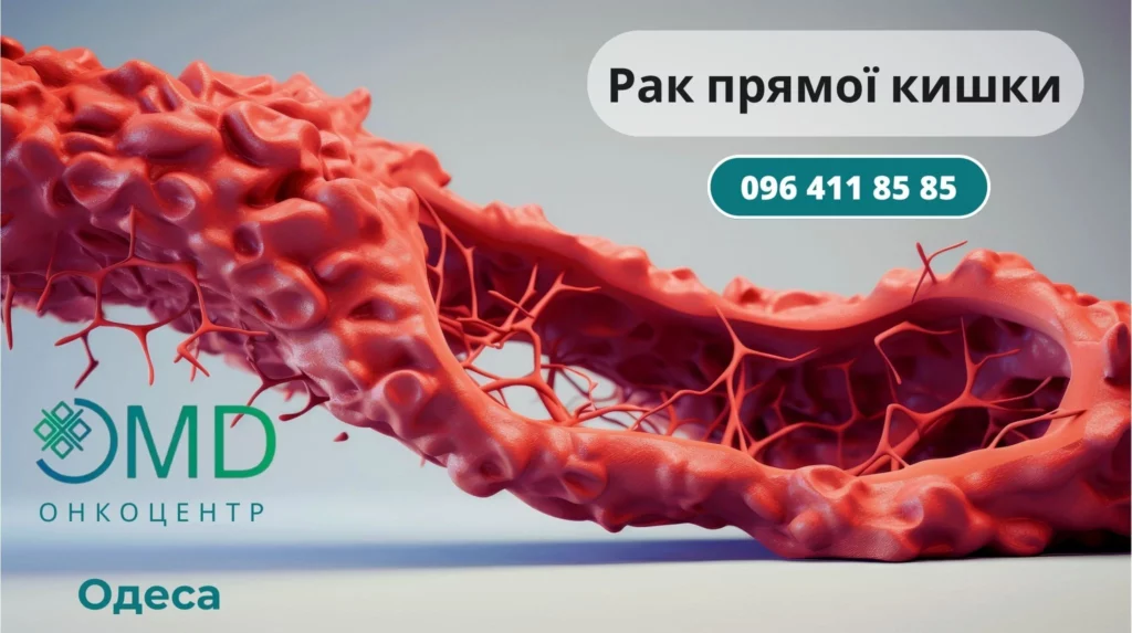 Рак прямой кишки Лечение и диагностика Одесса Онкоцентр Одесса ОМД Одесса