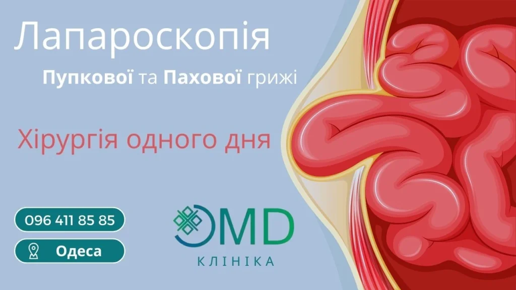 Лапароскопия пупочной и паховой грыжи в Одессе Хирургия одного дня