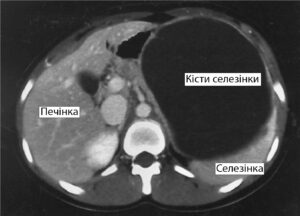 Кисты селезенки: что скрывается за этим диагнозом?